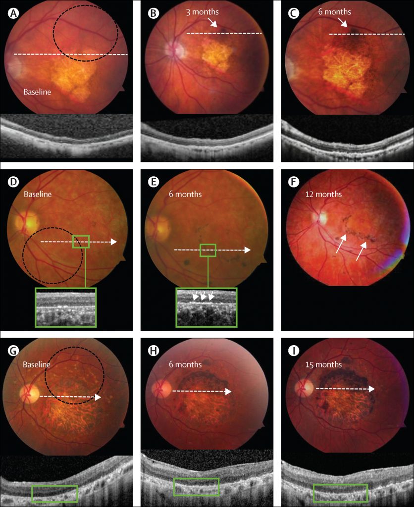 再生你的視力 —— 視網膜色素上皮 (retinal Pigment Epithelium) - The Investigator Taiwan